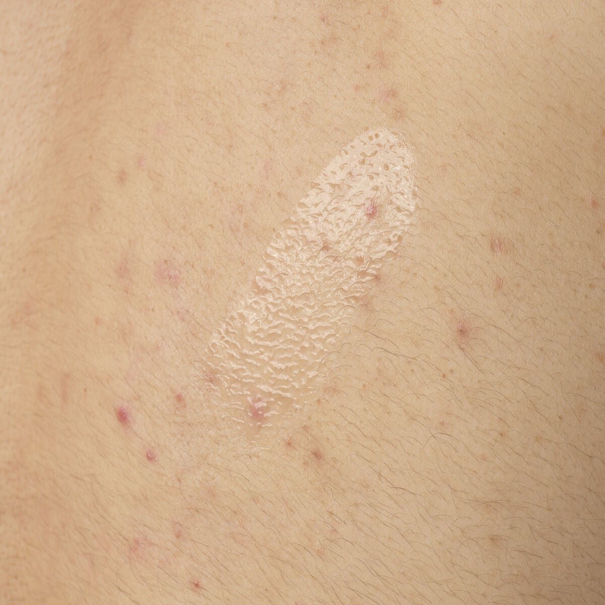 salicylic-acid-0-5-body-serum-n3 ORD-salicylic-acid-05-body-240ml-application.jpg