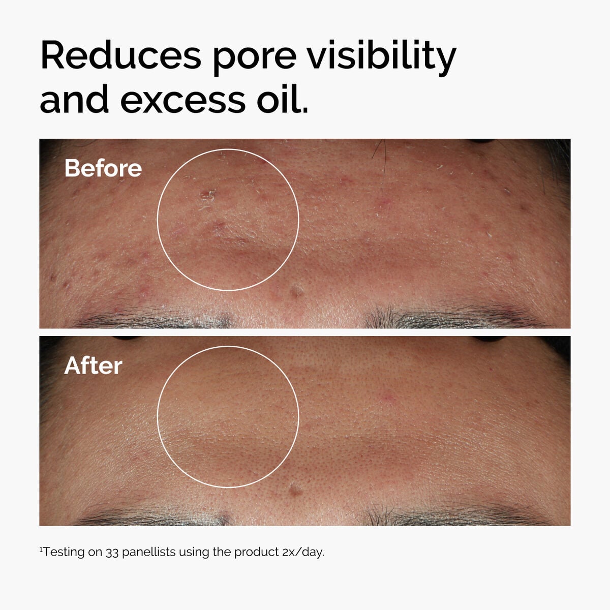 niacinamide-10-zinc-1-u3 ord-niacinamide-zinc-blemish-serum-before-after-pores.jpg