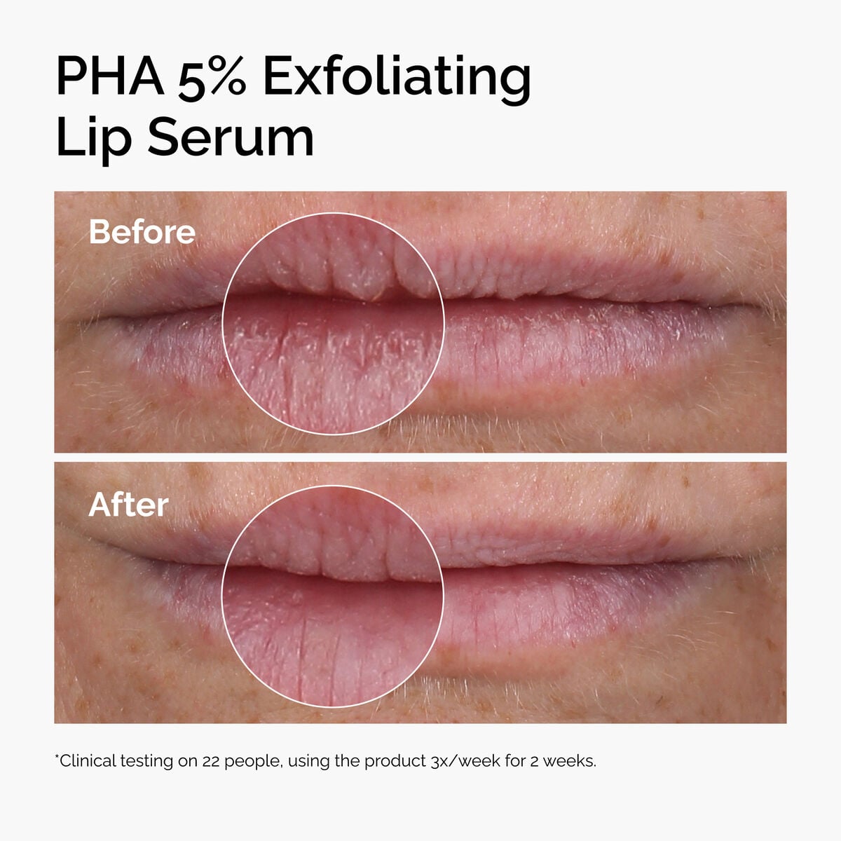 pha-5-exfoliating-lip-serum-f3 ord-pha-5pct-lip-exfoliating-serum-before-after.jpg