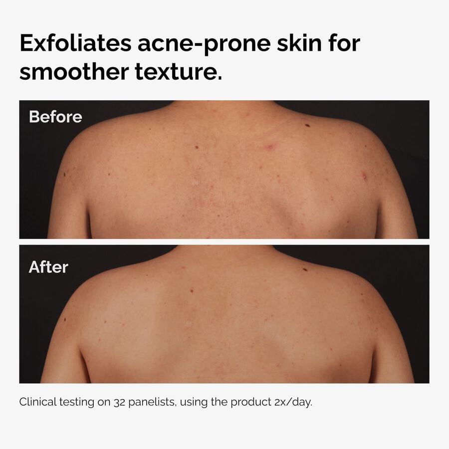 the-body-care-collection-u5 ord-salicylic-acid-body-serum-before-after-graphic-NA.jpg