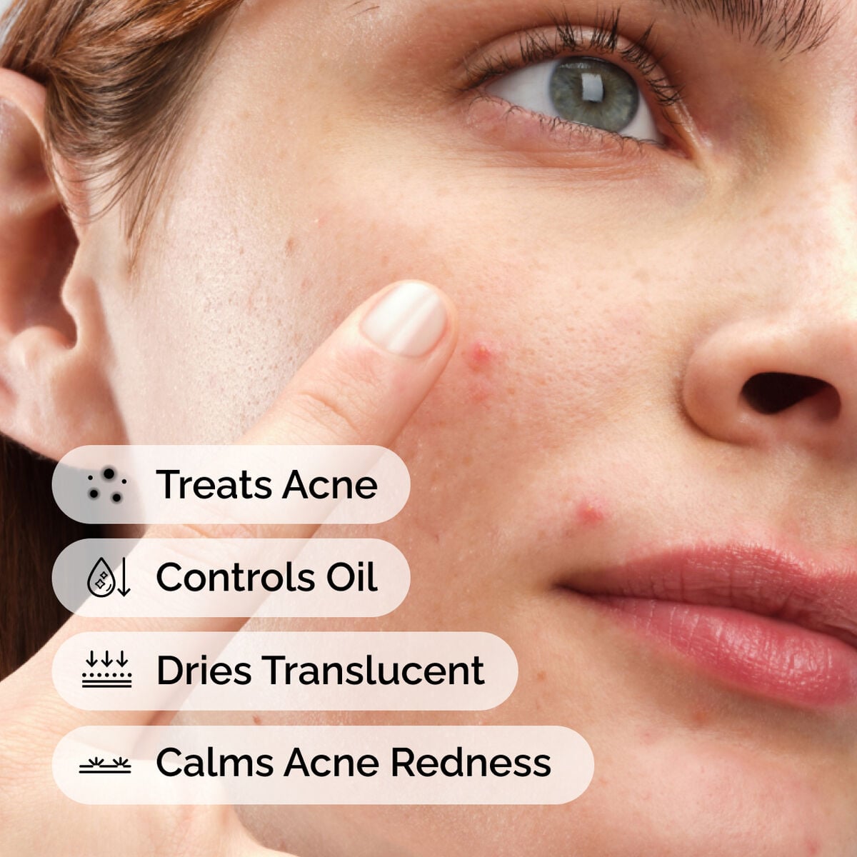 sulfur-10-powder-to-cream-concentrate-o6 ord-sulfur-10pct-powder-to-cream-concentrate-model-application-with-benefits-acne.jpg
