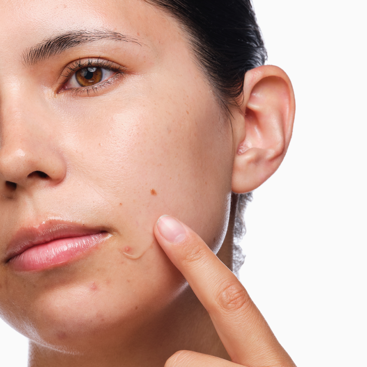 the-acne-set-r5 rdn-the-acne-set-application.png